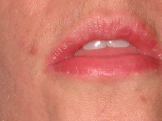 exfoliative cheilitis