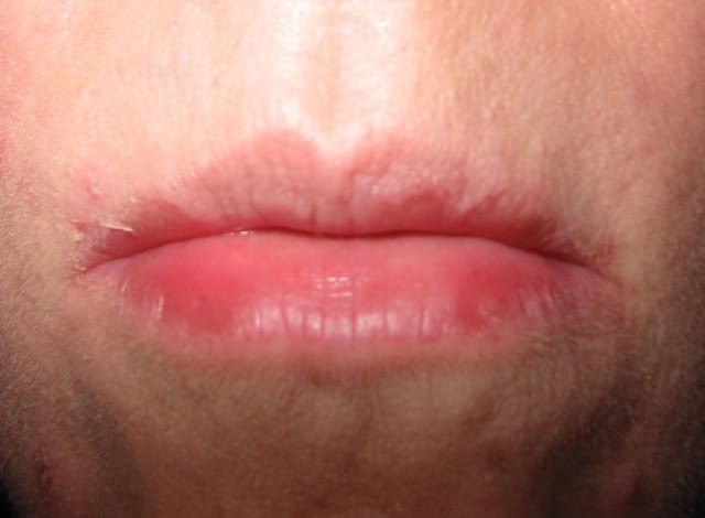 exfoliative cheilitis