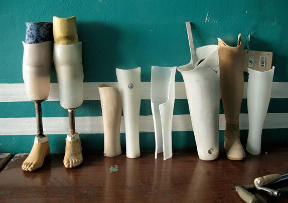 legs Prosthetics at an Orthopedic center