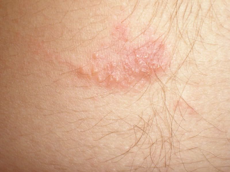 "Waistline rash Pics provided" Skin Problems & Treatments Community